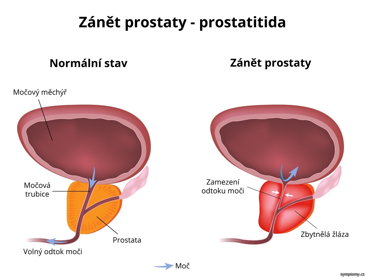 Zanet-prostaty-prostatitida